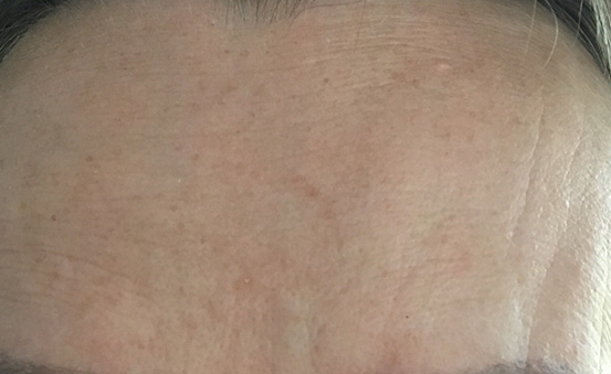 Przed/Po Botox#1