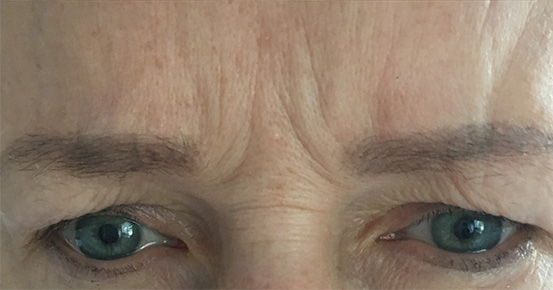 Przed/Po Botox#2