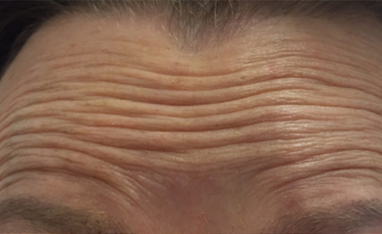 Przed/Po Botox#1