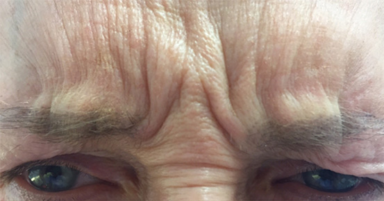 Przed/Po Botox#2